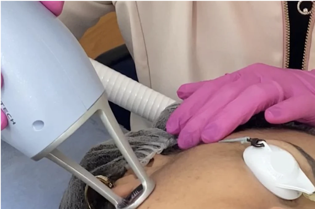 Aplicação do laser Lavieen com proteção ocular