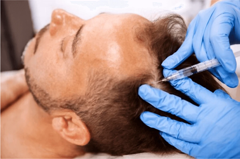 Aplicação de mesoterapia no couro cabeludo